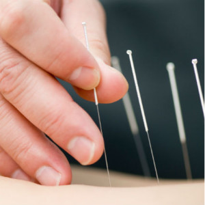 acupuncture R